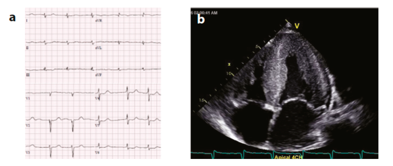 amiloidosis