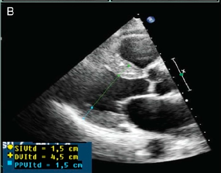 amiloidosis