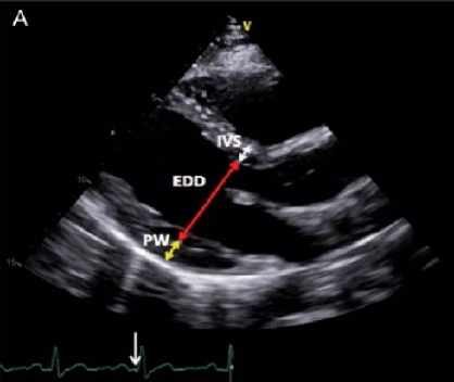 amiloidosis