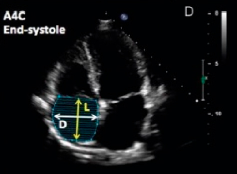 amiloidosis