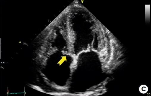 amiloidosis