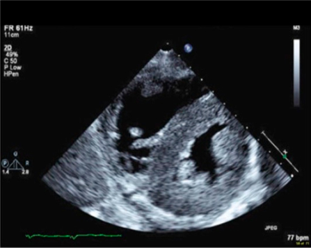 amiloidosis