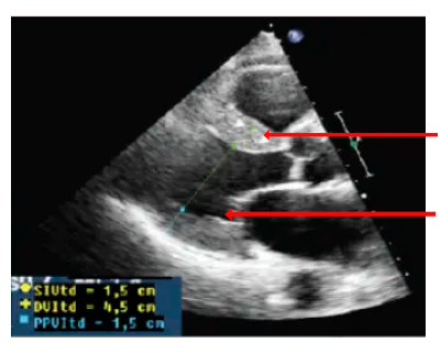 amiloidosis